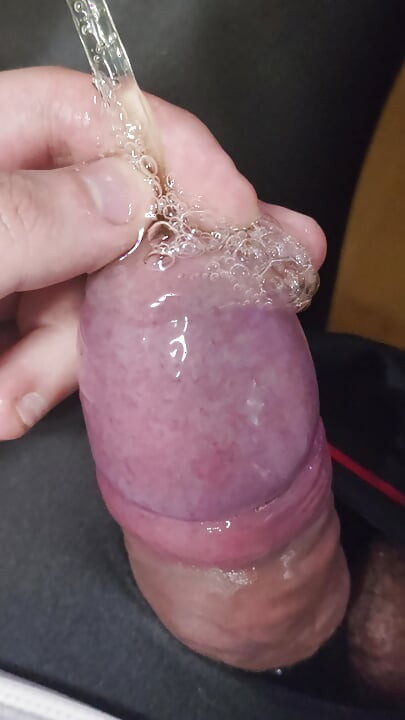 Mi-am injectat gel din urină în vezică