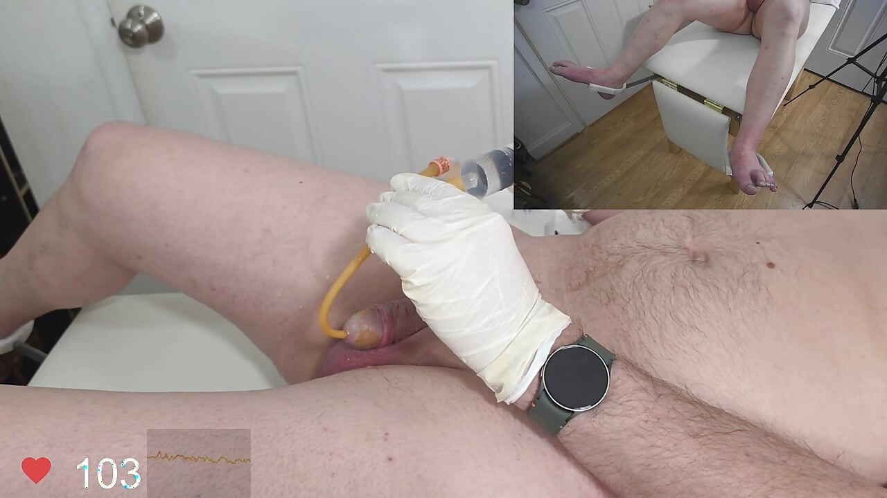 Foley 导尿管和膀胱填充