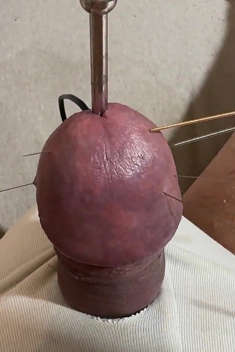 The Best Acupuncture Method!