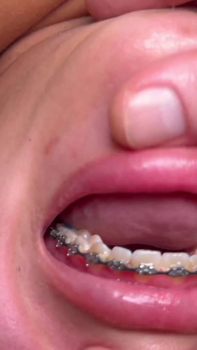 Brace Faced Teen Amira Mae Rough Throat Fucking & Ass Eating