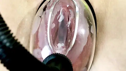 Vakum pompasının etkisi altında vajinal deformasyon