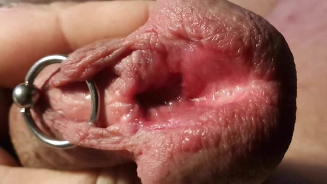 Subincision
