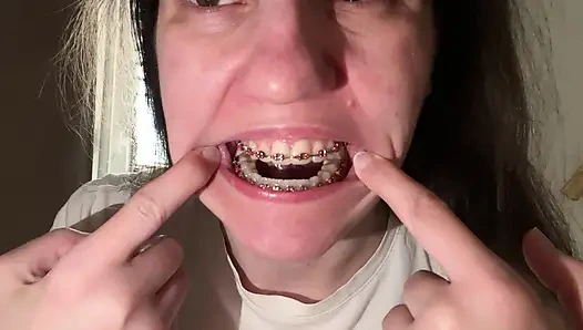 Licking Your Braces with Your Tongue