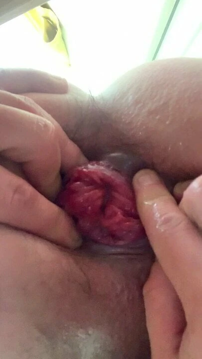 Prolapse Anal
