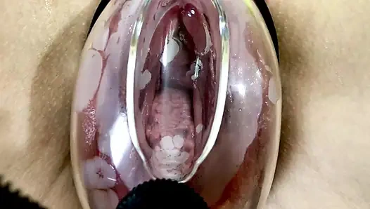 Deformasi Vagina Di Bawah Pengaruh Pompa Vakum