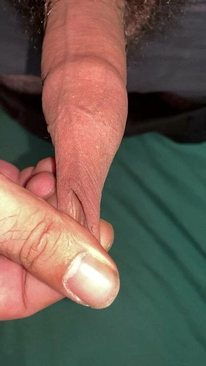 Me And my long foreskin