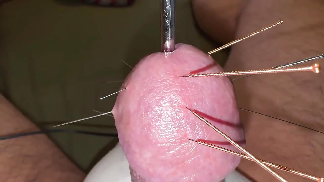 Acupuncture - Orgasm!