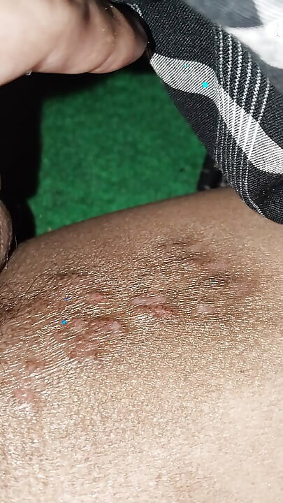 흑인 치아로 피부를 치료하는 방법에 대한 튜토리얼