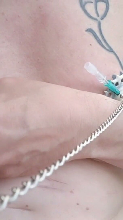 6 needles through the nipples stretched by plastic flower ring with holes on the terrace outside | Clip 1