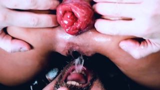 Prolapsus anal, mari buvant de la pisse