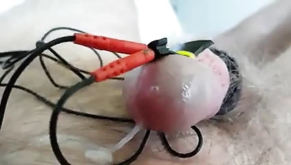 Tahmini elektro stimülasyon