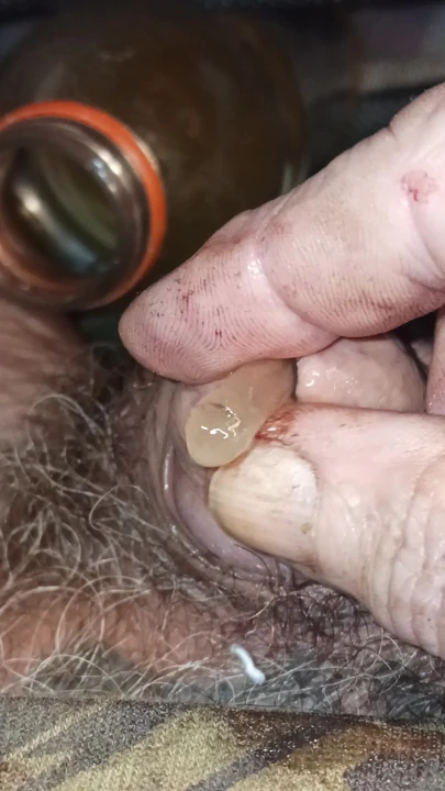 Catéter en mi polla
