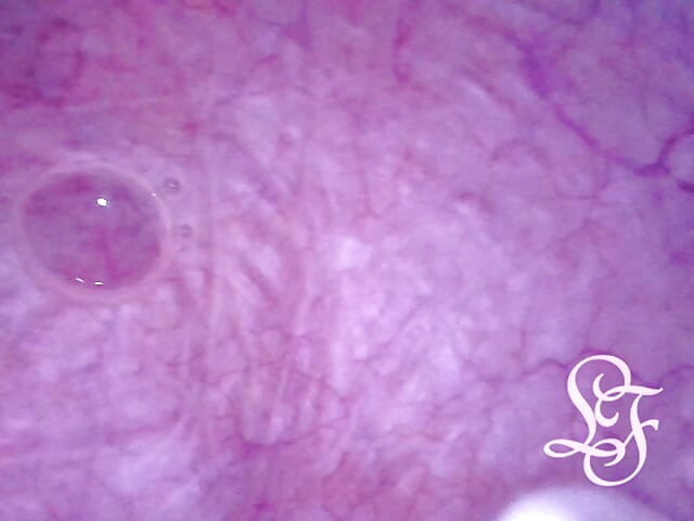 Can I fit the minicam AND a catheter inside my pee hole at the same time?