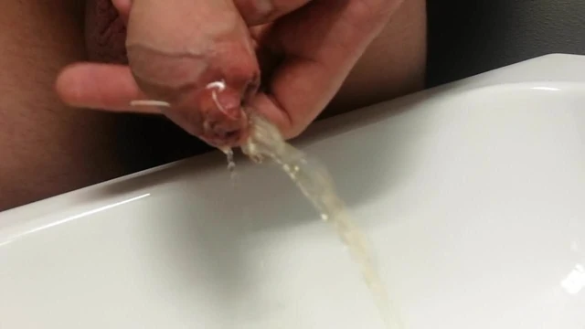 Stapled foreskin & pissing
