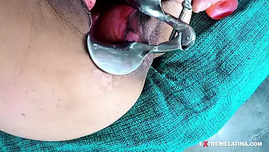 Exl-032: Huge Speculum in Ass N Pussy. Huge Prolapse and Huge Cervix. Full Extremelatina Scene Exl-032