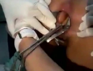 Cirurgia para retirada de brinquedo erotico do cu