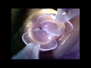 Endoscópio em 2 colheres empurrando para dentro da uretra - exploração do pau