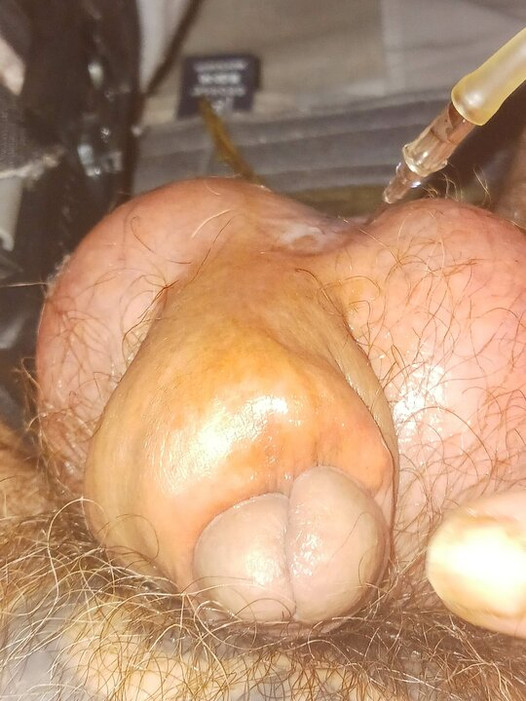 CBT Bruning of Little Cock Head Gland with Cigarette Repeatedly