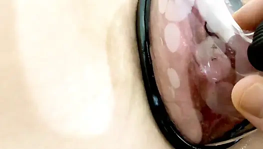 Vaginale Vaginale unter dem Einfluss einer Vakuumpumpe