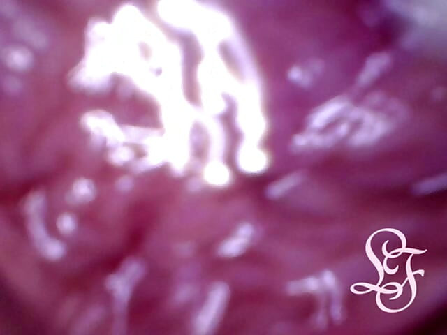 Can I fit the minicam AND a catheter inside my pee hole at the same time?