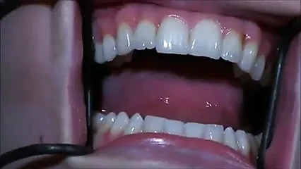 固定在铁棒上 2 Of 2