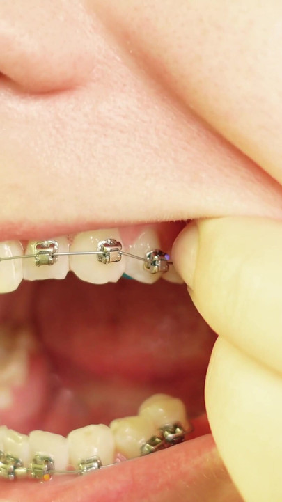 Iconic moment from "eating in braces - vore and food fetish - close up video"