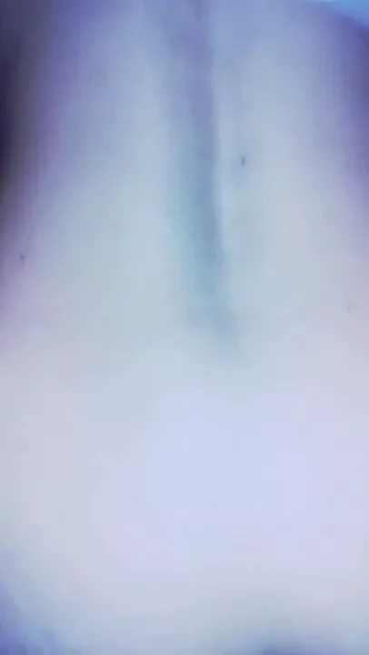 V dupeto