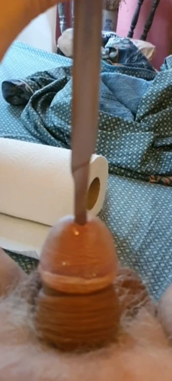 Fork in penis urethra