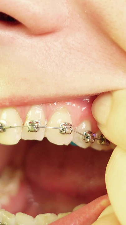 Iconic moment from "eating in braces - vore and food fetish - close up video"