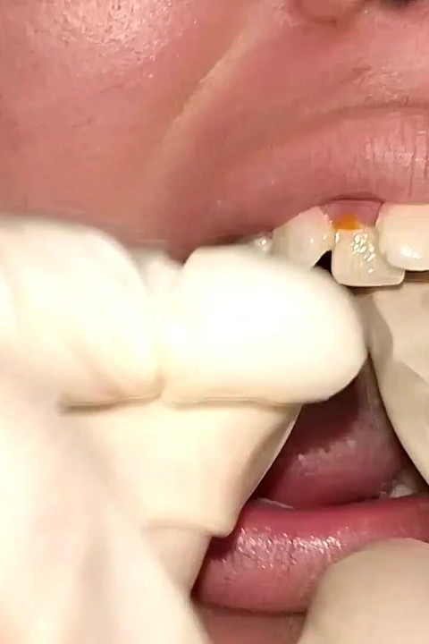 Trying to Use Dental Floss (close-up)