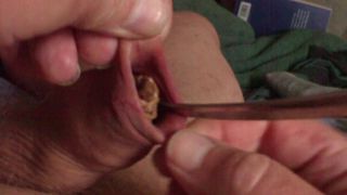 A spoon and a pine cone in foreskin - 3 minutes
