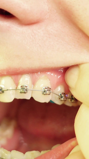 Iconic moment from "eating in braces - vore and food fetish - close up video"