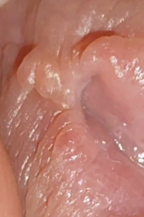 Enlargement of the Deep Urethral Hole!!