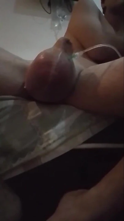 Key moment from "My journey of having 2L of D5NS turn my sac into a hot air balloon  (part1)"
