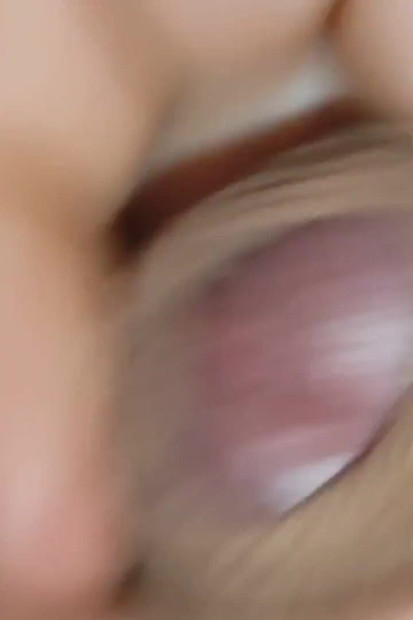 Amazing Dilator Vessel Has Disproportionate Increase.