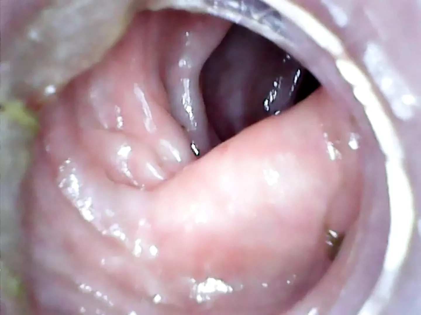 Endoscópio anal parte 2
