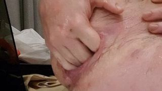 Fisting anal y prolapso