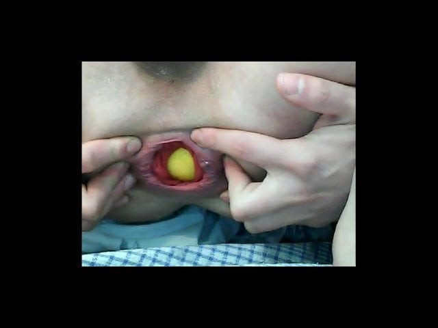 Prolapse close up 2