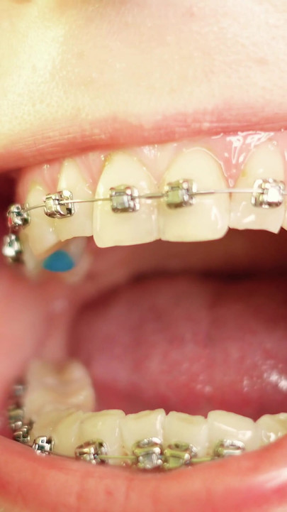 Iconic moment from "eating in braces - vore and food fetish - close up video"
