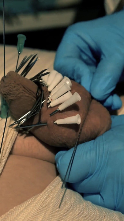 미라화, 주사, 인지행동치료, 전기 놀이가 포함된 의료 게임.