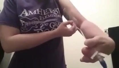 finger amputee