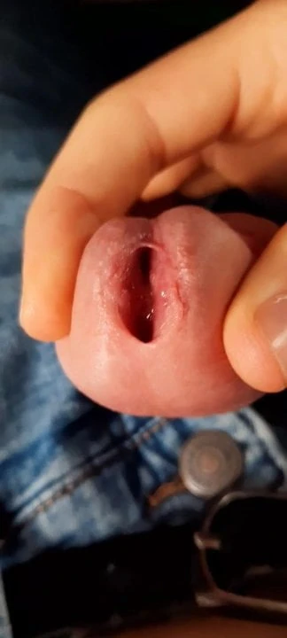 My foreskin deploying