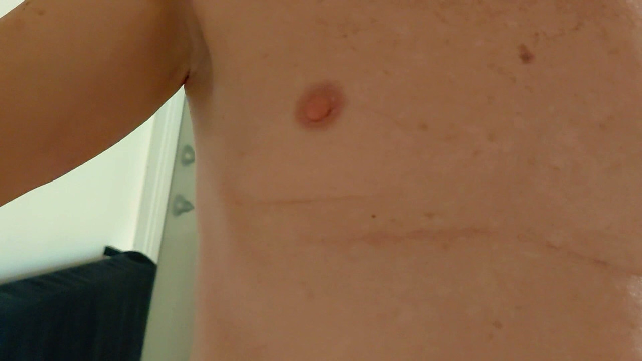 Do you think my laser hair removal is working?