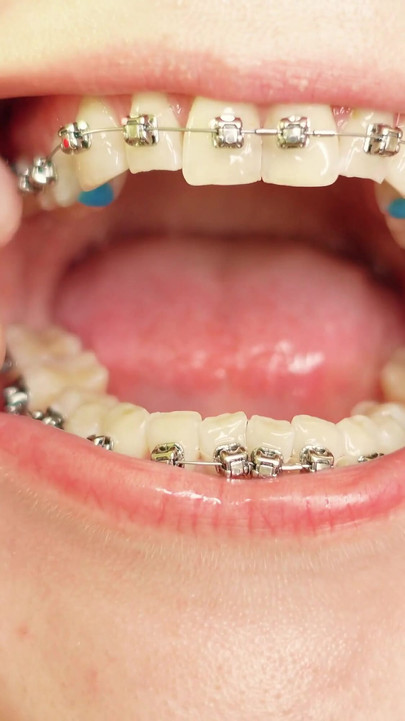 Iconic moment from "eating in braces - vore and food fetish - close up video"