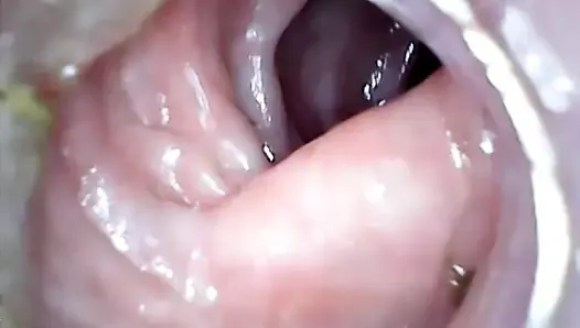 Anal endoscope part 2