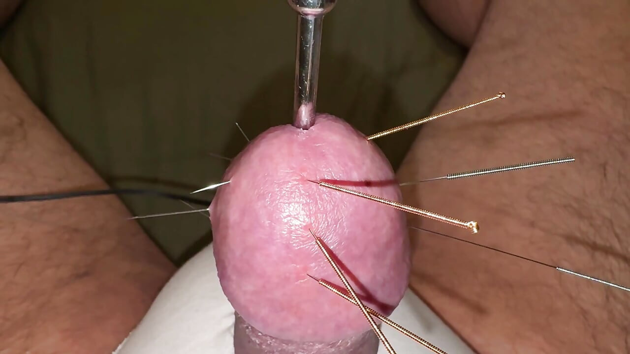 ¡acupuntura - ¡orgasmo!