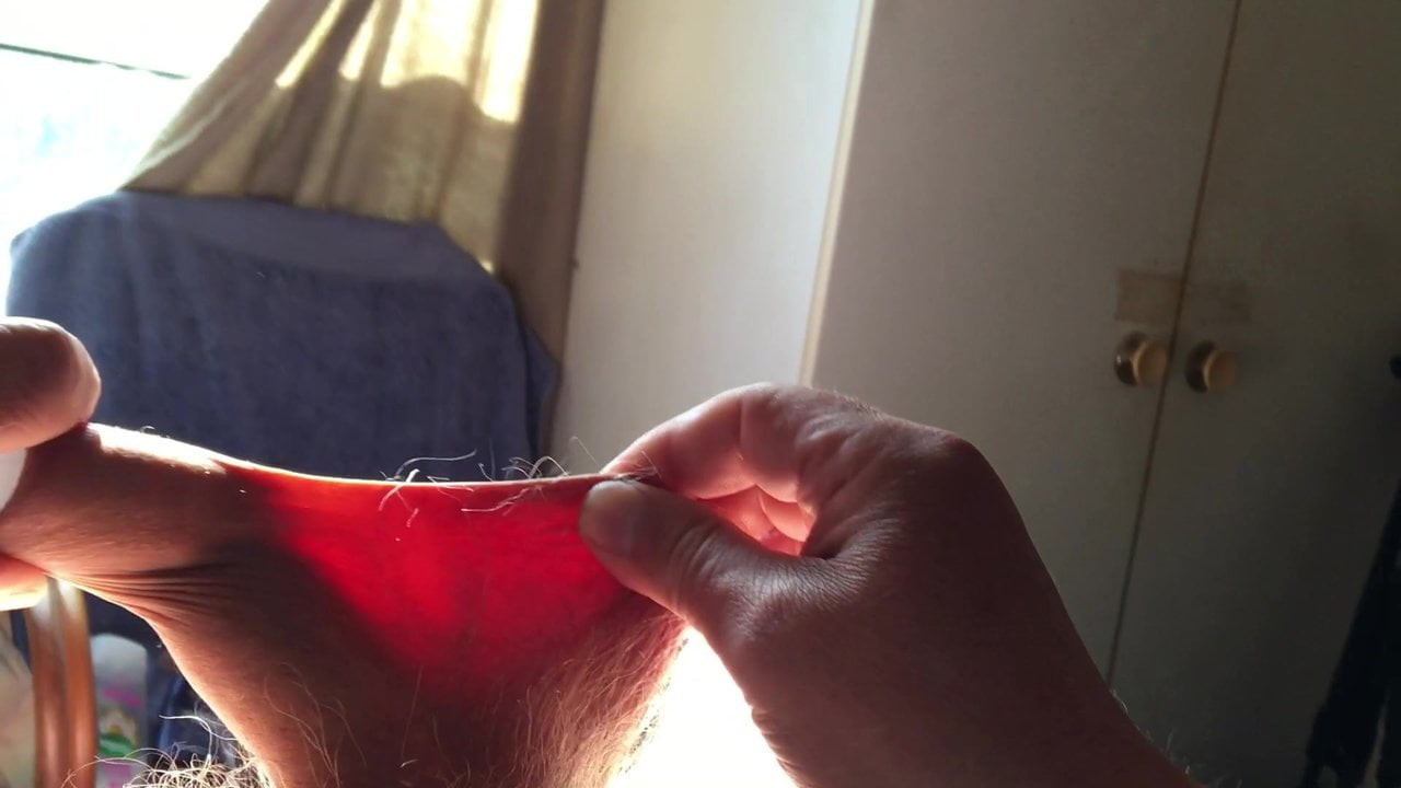 Sunshine foreskin - 7 of 8