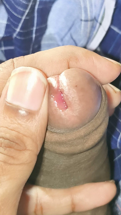 My penis has become thick and hard.