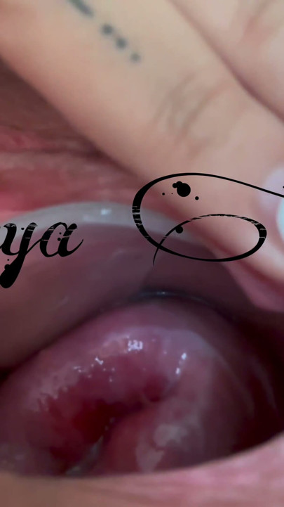 Small cervix without dilating | Clip 1