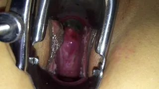 Deep view inside woman with speculum, nice view of cervix